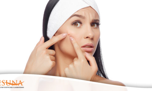 Trądzik – nie tylko młodzieńcza przypadłość