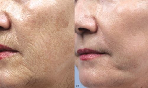 Na czym polega tzw. termolifting?