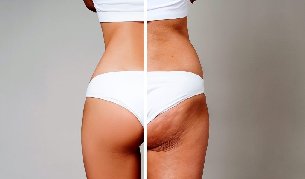 Female body before and after treatment. Plastic surgery. 3 sposoby na pozbycie się cellulitu i jędrną skórę.