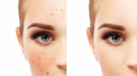 Trądzik – problem nie tylko nastolatków