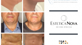 Lifting nieinwazyjny Endolift – co na jego temat mówią lekarze?